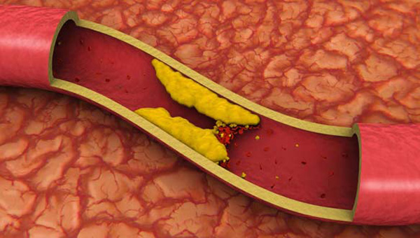 Cholesterol