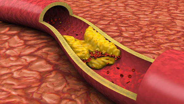 Atherosclerosis 